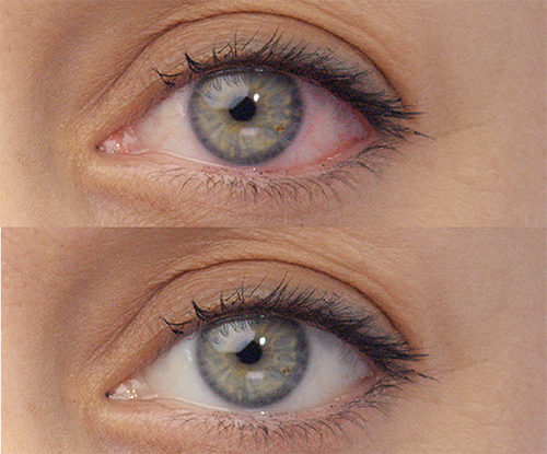 Before and after shot of an eye after using Lumify eye drops